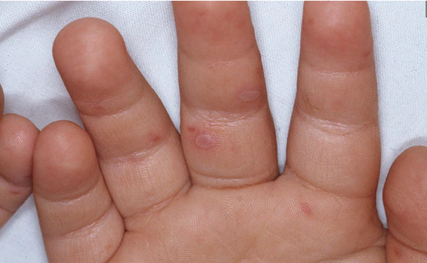 Enfermedad de manos, pies y boca en la mano