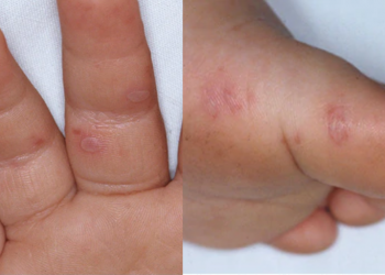 Registran 15 casos de niños con Virus Coxsackie A16 en Zacatecas