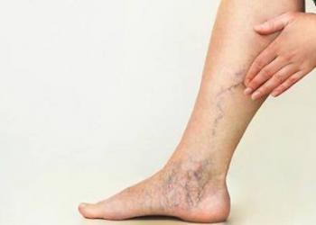 Atiende IMSS anualmente más de 37 mil casos de várices