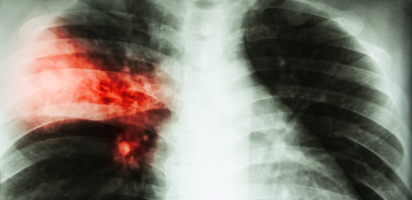 Así se ve la tuberculosis en los pulmones