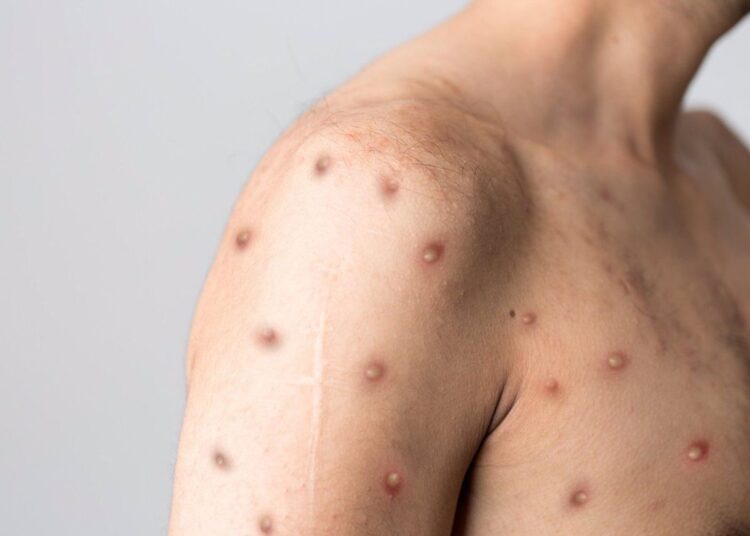 Posible contagio de viruela del mono activa protocolos en Sinaloa; investigan caso sospechoso