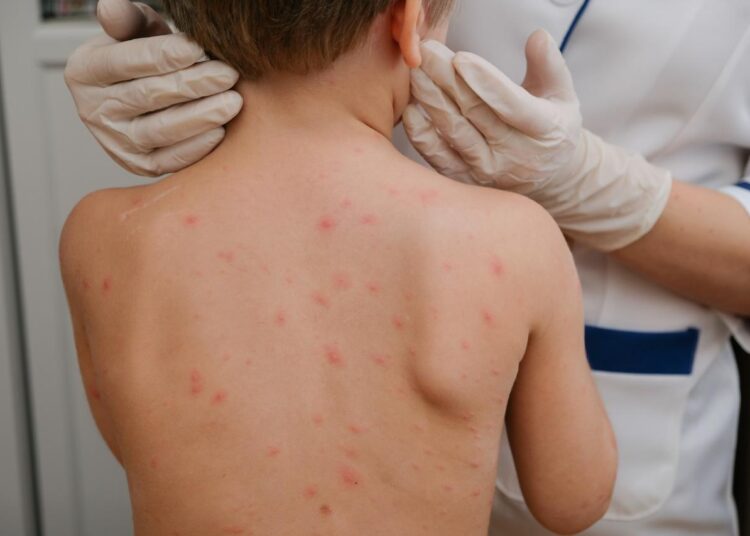 Detecta SSZ un caso de contagio de Sarampión en Huanusco