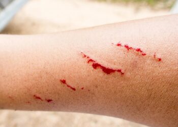 Registran primer caso de rabia humana en Zacatecas