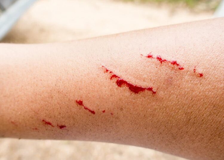 Registran primer caso de rabia humana en Zacatecas