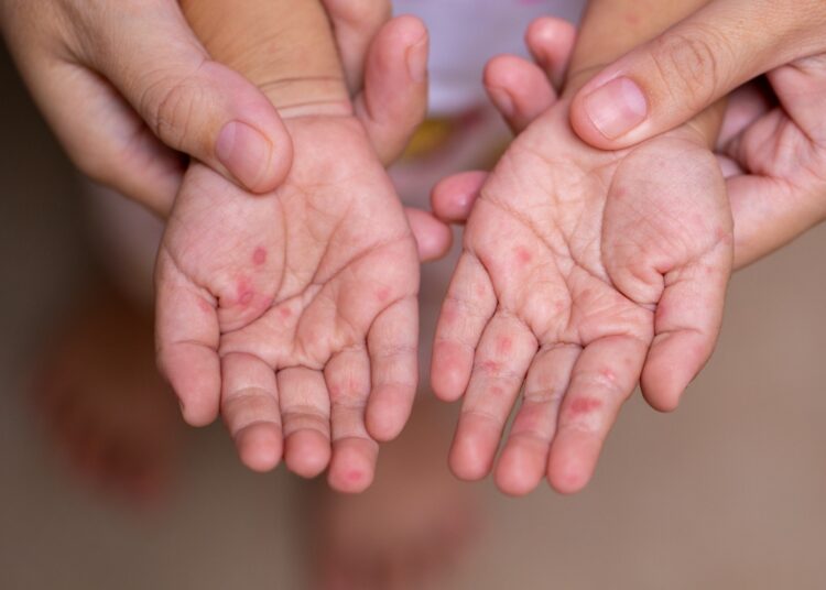 El virus Coxsackie afecta a 130 personas en Fresnillo, Zacatecas y Guadalupe