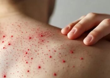 Zacatecas registra el primer caso de Sarampión del año; están confirmados 23 positivos